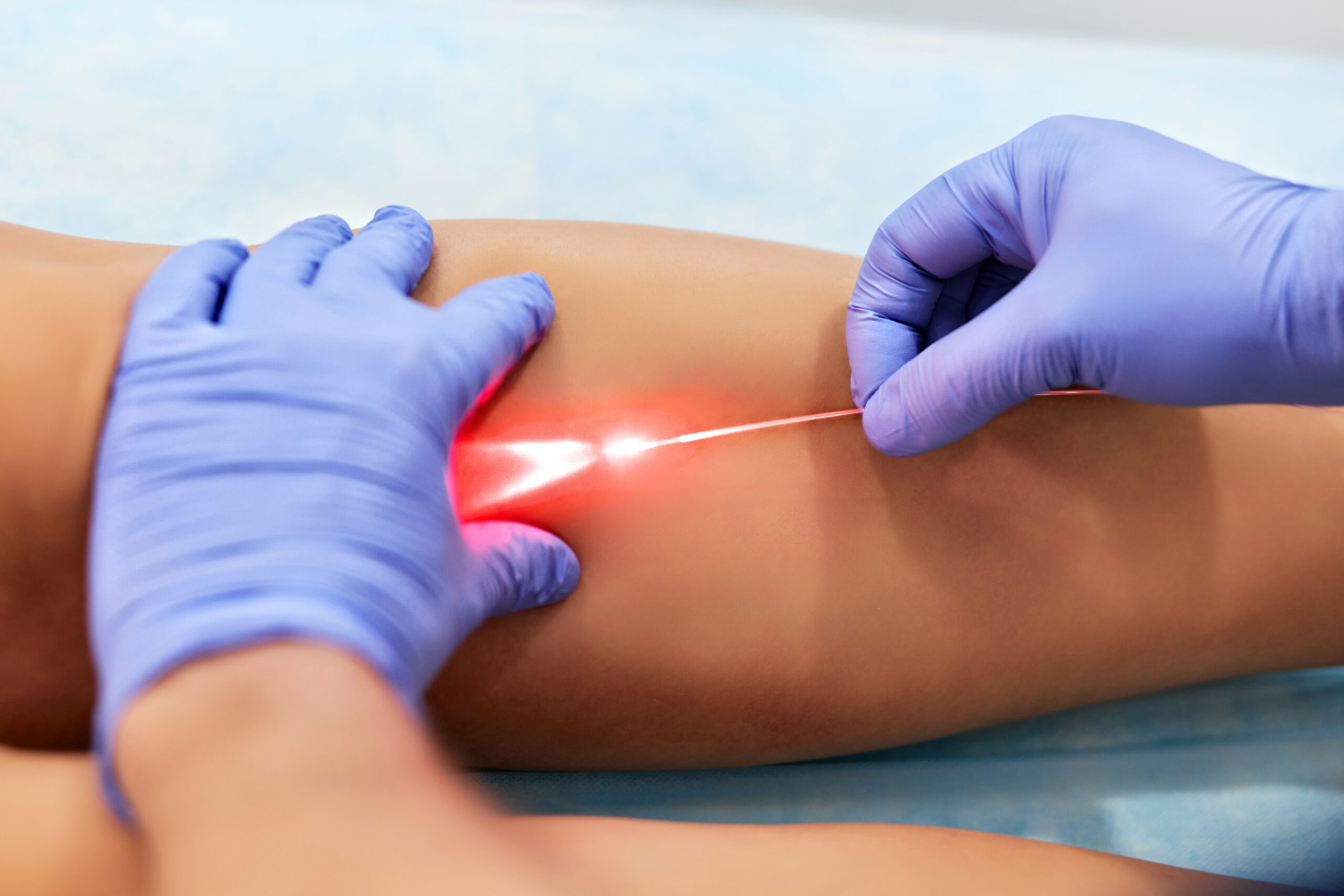 varicose laser treatment female legs clinic